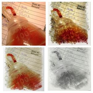 Drain for the groin lymph node area. A tube is in place to remove excess fluid to prevent edema. I measure it twice a day and dump it out. 